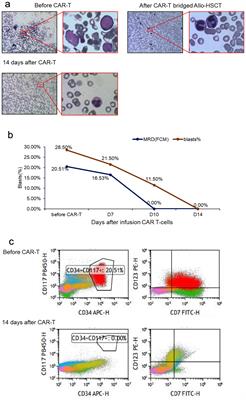 Naturally selected CD7-directed CAR-T bridging allo-HSCT in refractory acute myeloid leukemia: a case report and review